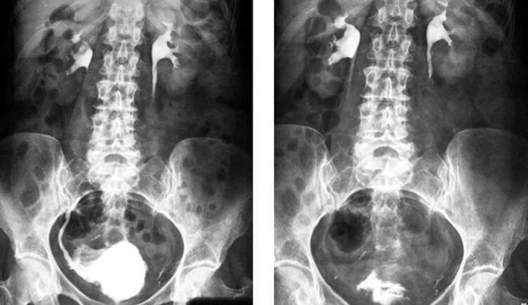 Prostatit tanısı için ürografi